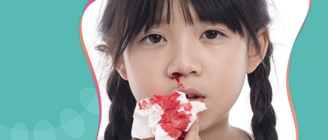 nosebleed in Tagalog