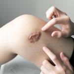ano ang keloid